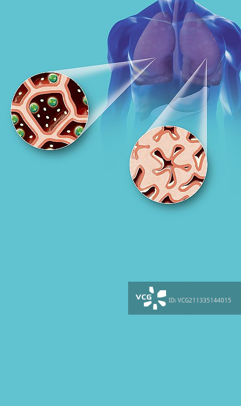 哮喘与黏液过度生成医学插画图片素材