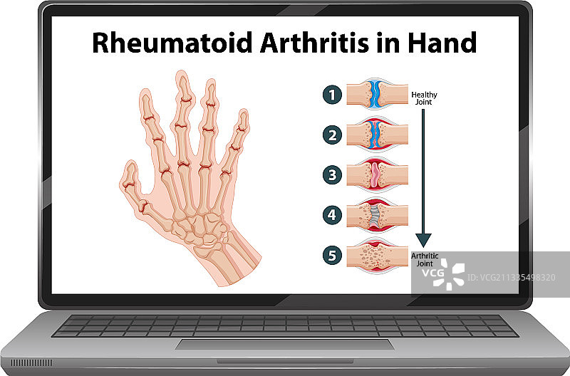 笔记本电脑上手部类风湿性关节炎症状图片素材