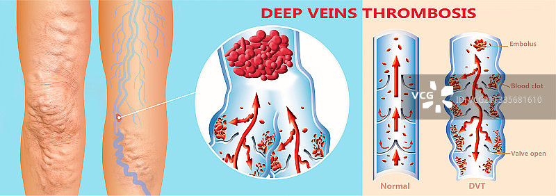 深静脉血栓或血栓栓塞图片素材
