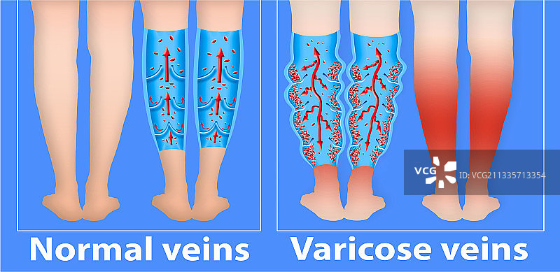 老年女性腿部的静脉曲张图片素材