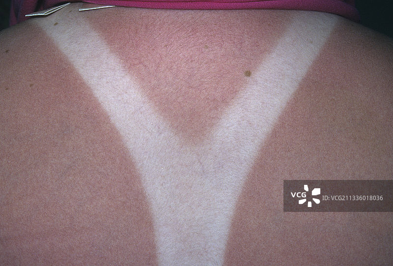 晒伤的人类皮肤图片素材