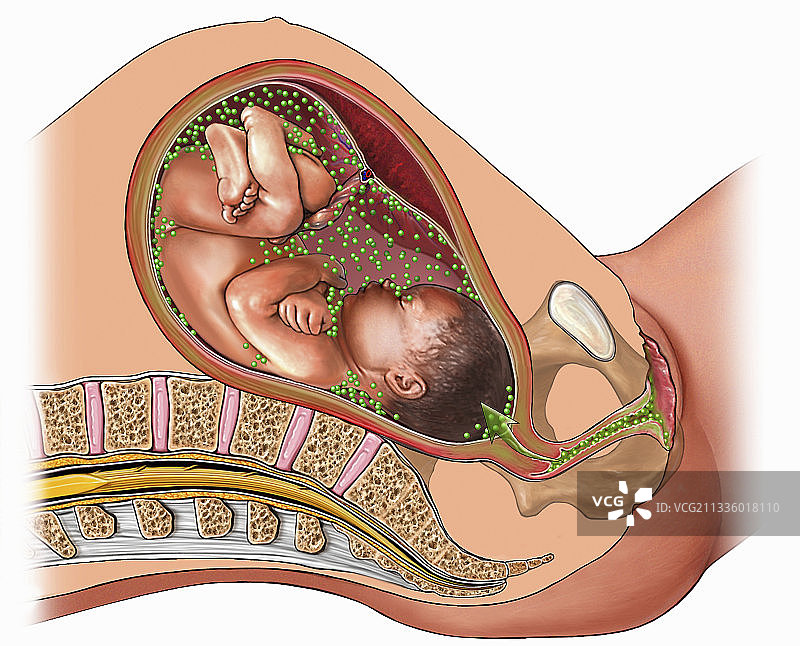 分娩并发症插画图片素材