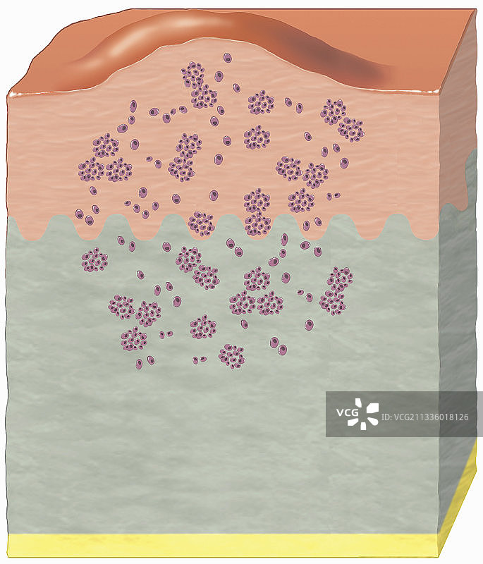 皮肤癌-恶性黑色素瘤图片素材