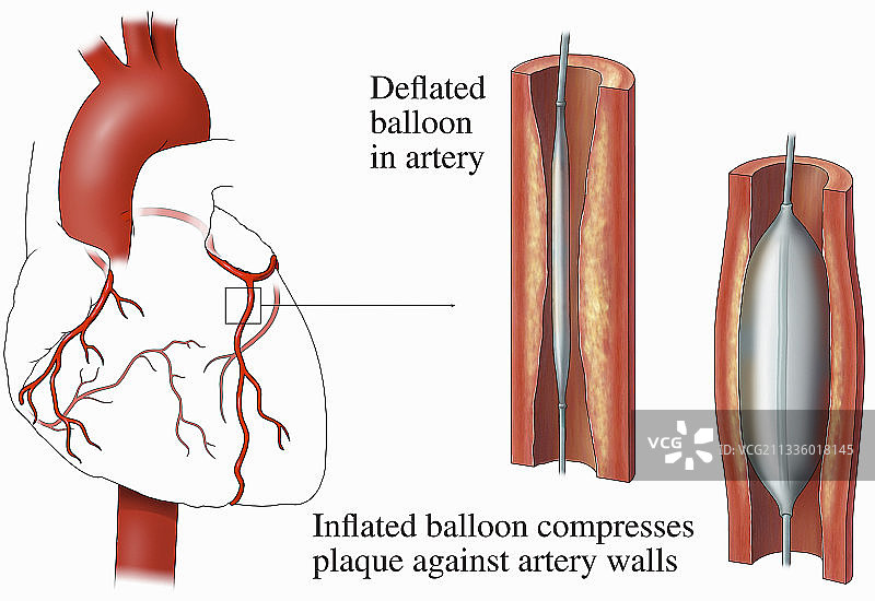 球囊血管成形术插画图片素材