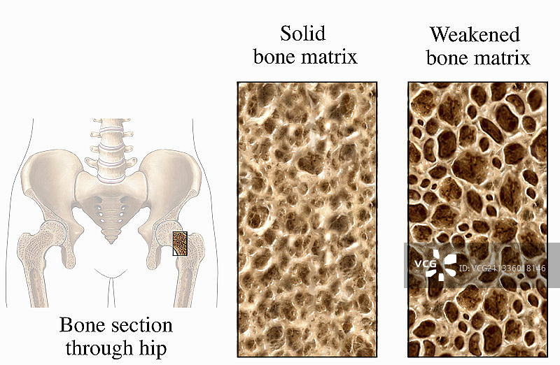 骨质疏松症插画图片素材