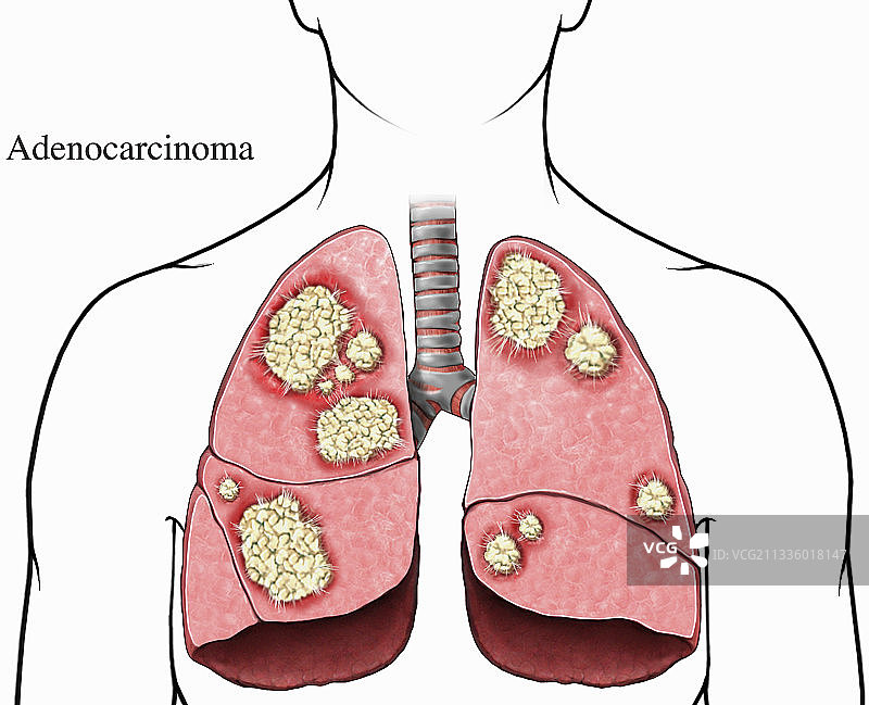 侵入性肺肿瘤插图图片素材