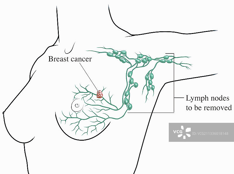 乳腺癌手术插画图片素材