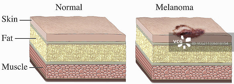 恶性黑色素瘤皮肤癌细胞图片素材
