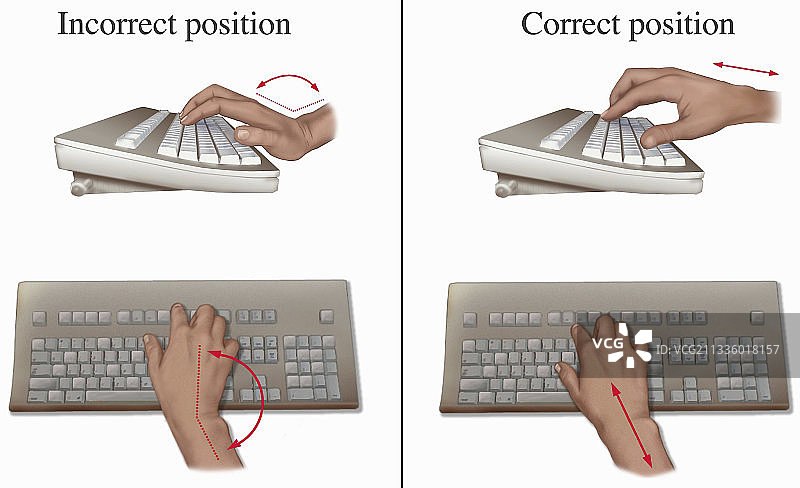 避免腕管综合征插画图片素材