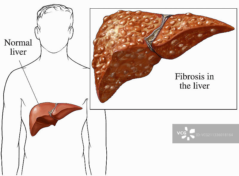 肝硬化插画图片素材