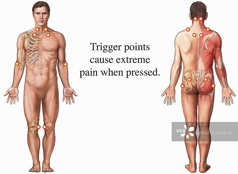 纤维肌痛插画图片素材