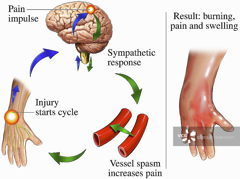 反射性交感神经营养不良手腕图片素材
