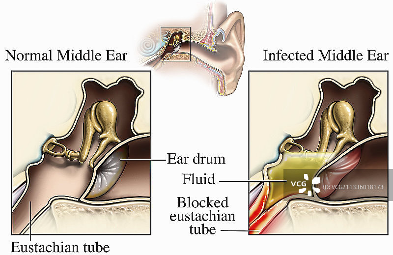 正常与感染的中耳插画图片素材