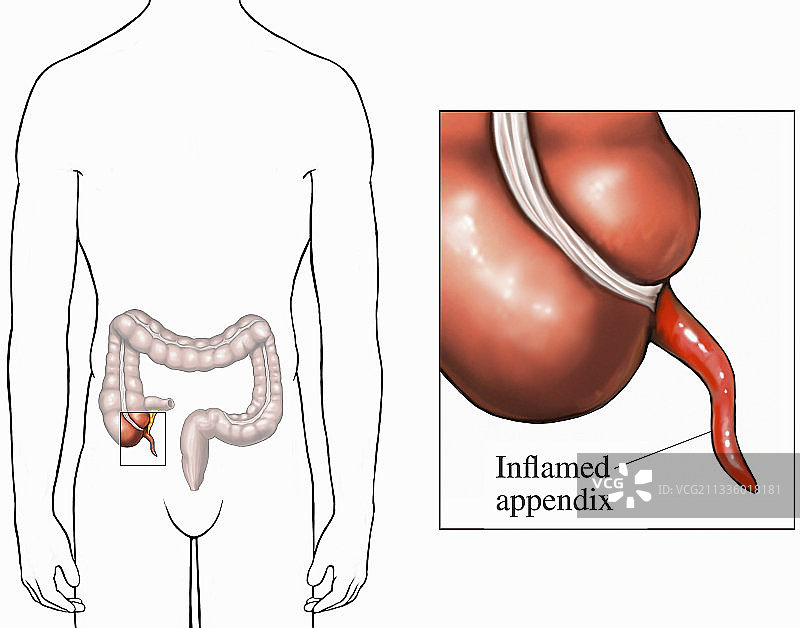 阑尾炎生物医学插图图片素材