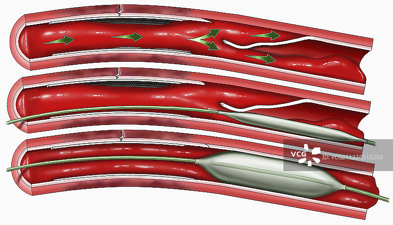 冠状动脉心脏手术图片素材