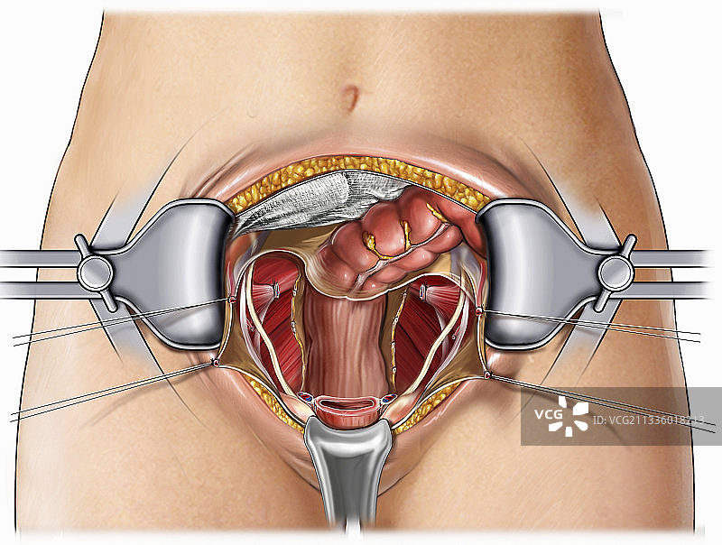 腹部手术插画图片素材