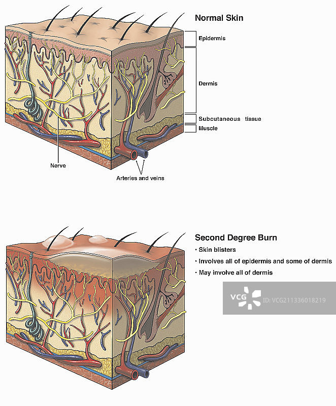 烧伤皮肤损伤插画图片素材