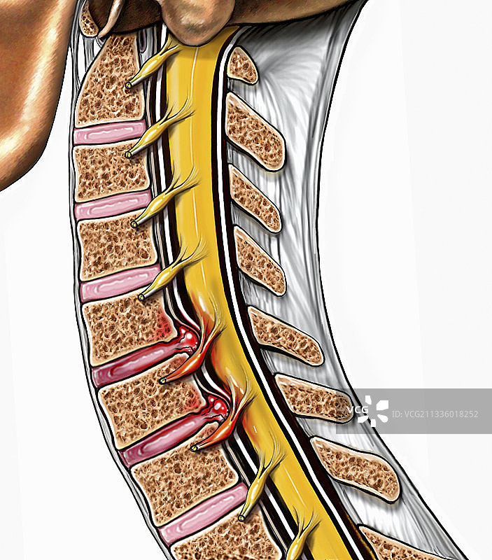 挥鞭伤图示图片素材