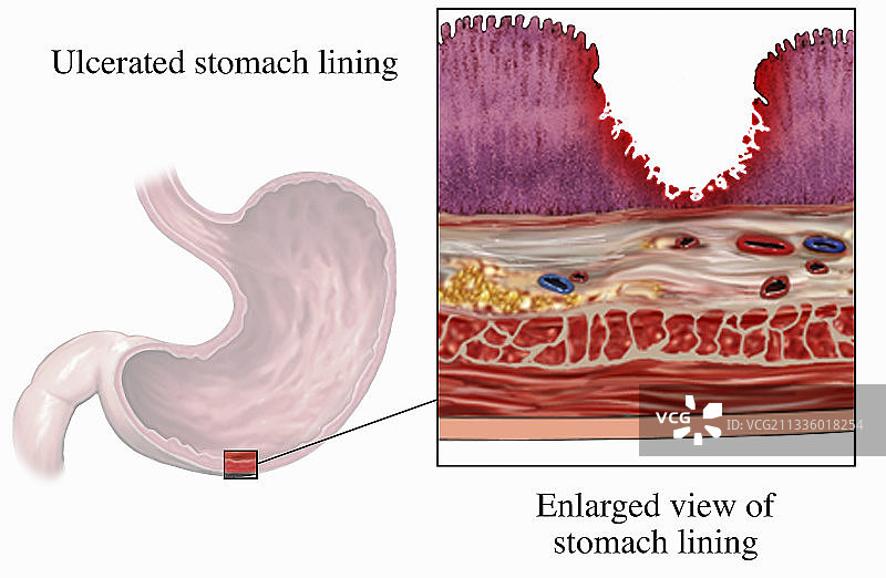 急性胃溃疡插图图片素材
