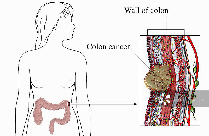 腹部肿瘤插画图片素材