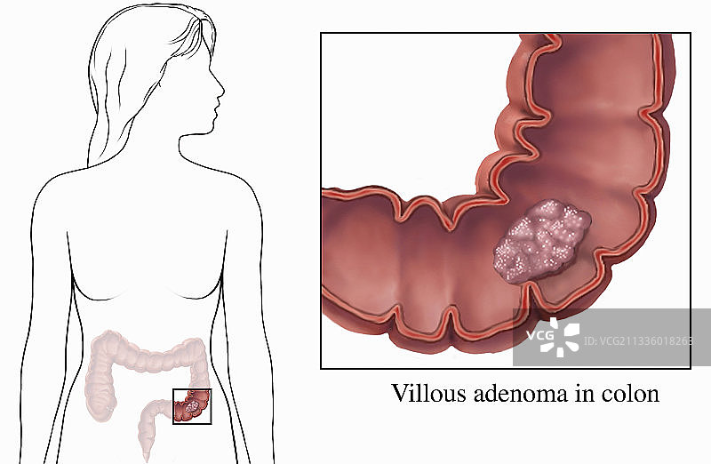 绒毛状腺瘤插画图片素材