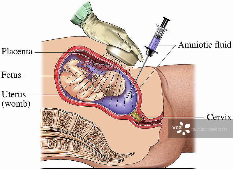 羊膜穿刺术医学图图片素材