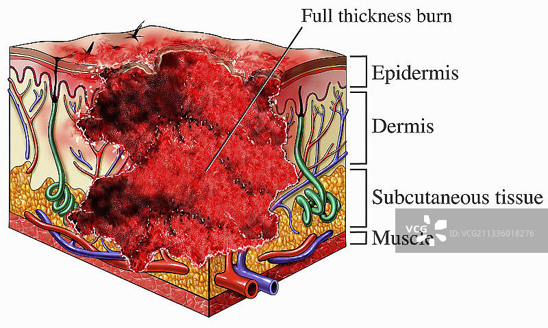 三度皮肤烧伤插画图片素材