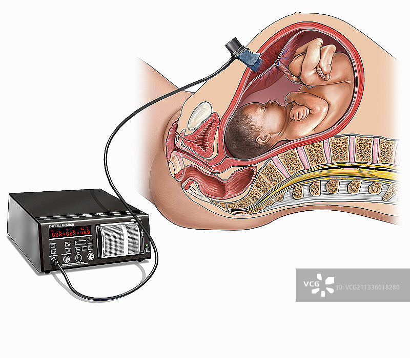 胎儿心率监护仪医学插图图片素材