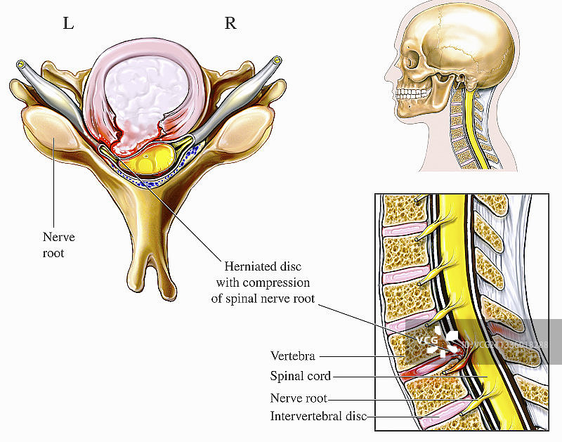 颈椎间盘突出图示图片素材