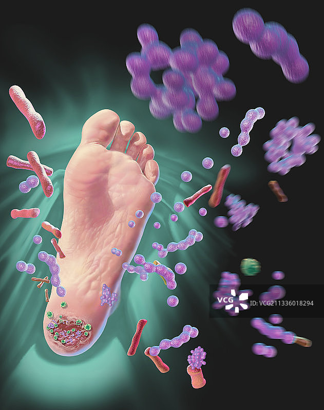 足部溃疡图片素材