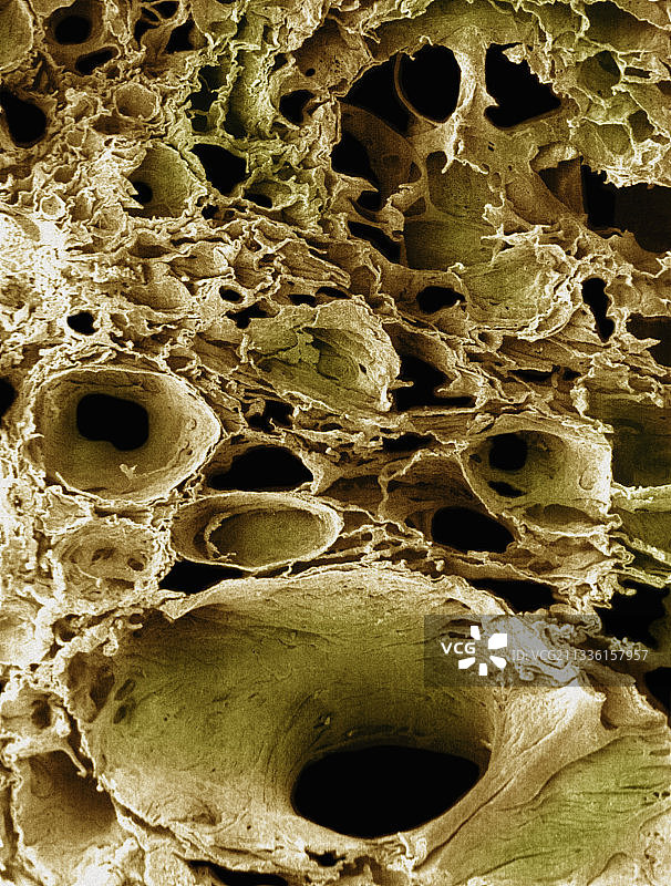 显示肺气肿的人类肺部图片素材