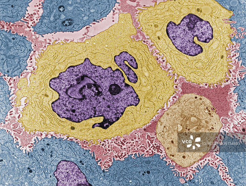 人脑中的腺癌细胞图片素材