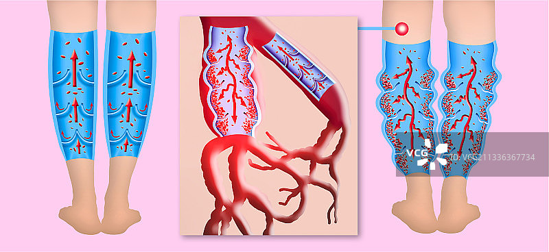 老年女性腿部的静脉曲张图片素材