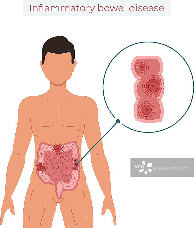 白色背景上的炎症性肠病图片素材