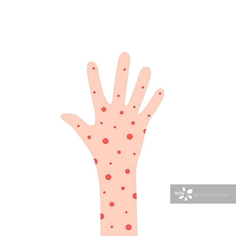 卡通手部过敏红疹图片素材