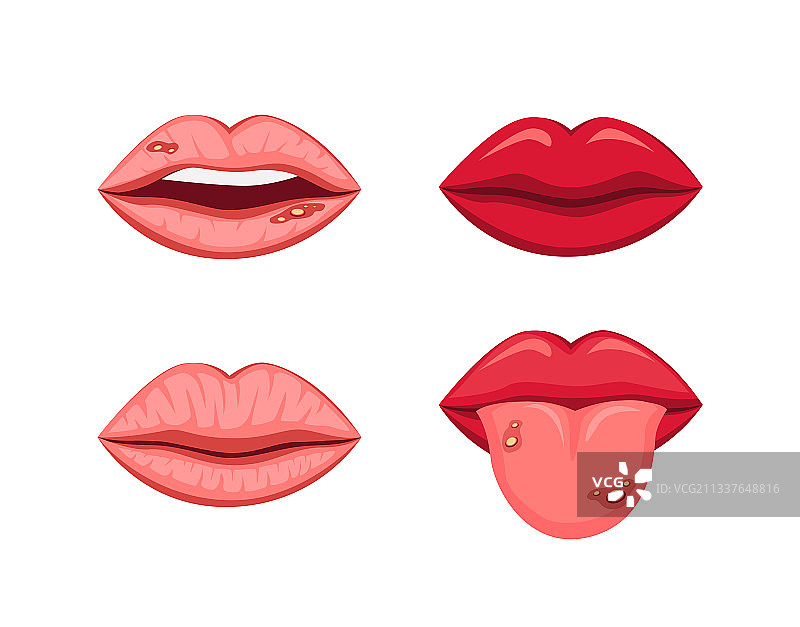 舌头健康与溃疡的嘴唇图片素材