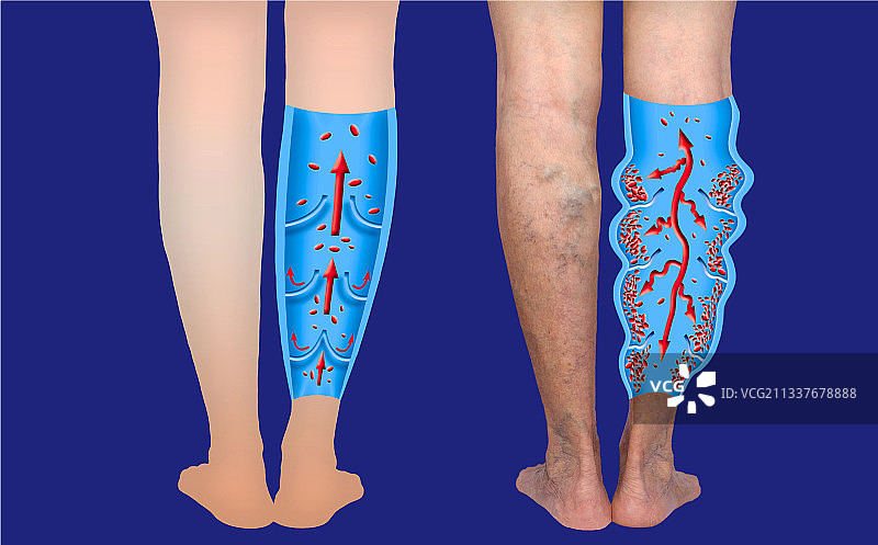 老年女性腿部的静脉曲张图片素材