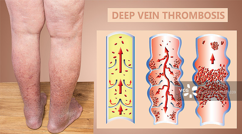 深静脉血栓或血栓栓塞图片素材