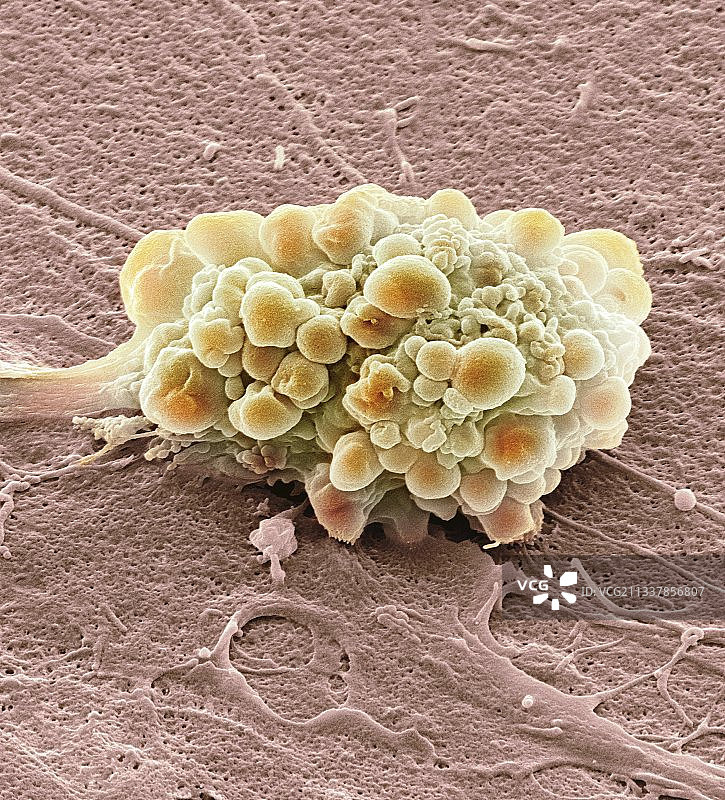 脑肿瘤图片素材