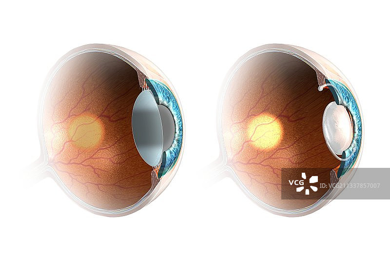 视力矫正艺术作品图片素材