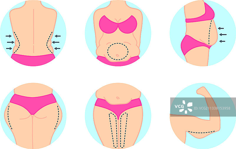 抽脂手术：臀部、大腿和腹部塑形图片素材