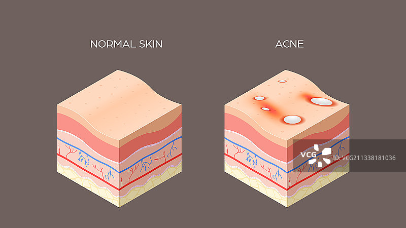 寻常痤疮或丘疹和正常皮肤交叉图片素材