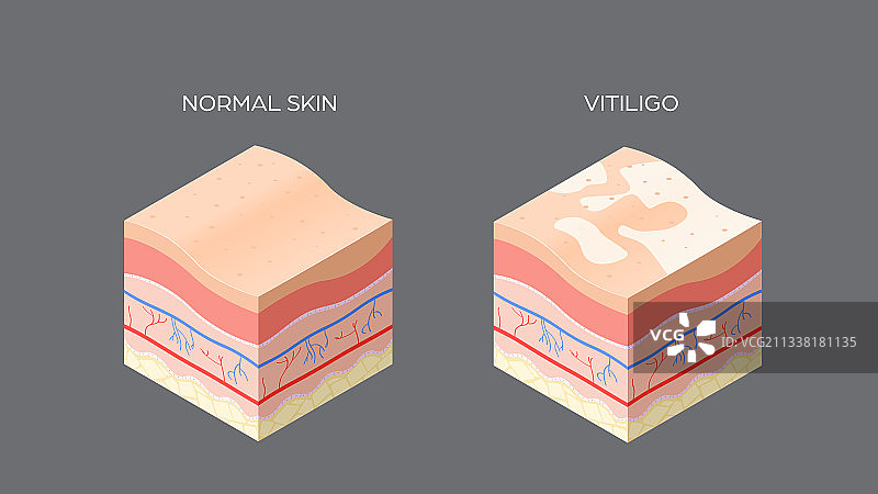白癜风与正常皮肤横截面图片素材