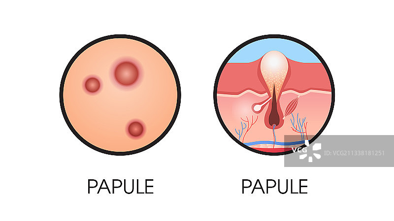 丘疹粉刺痤疮类型面部毛孔图片素材