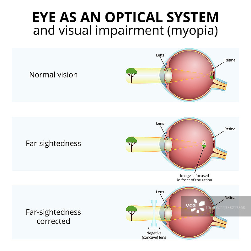 眼球结构视觉障碍图片素材