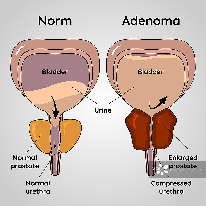 正常膀胱与前列腺增生问题示意图图片素材