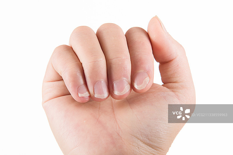 指甲病变发空图片素材