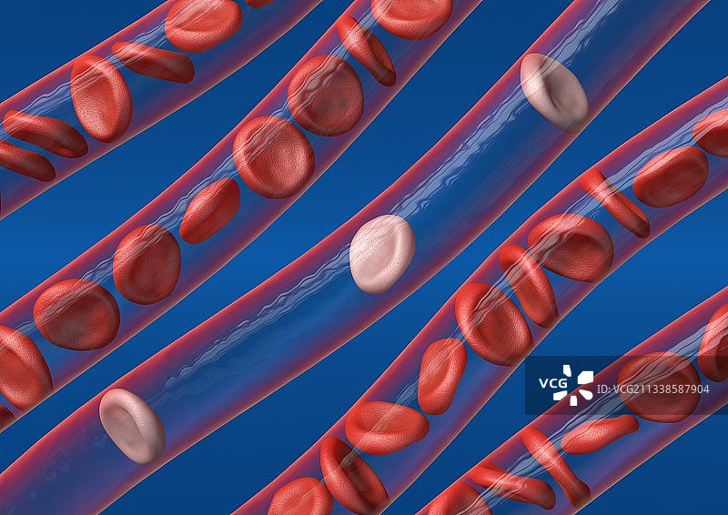 贫血概念图图片素材