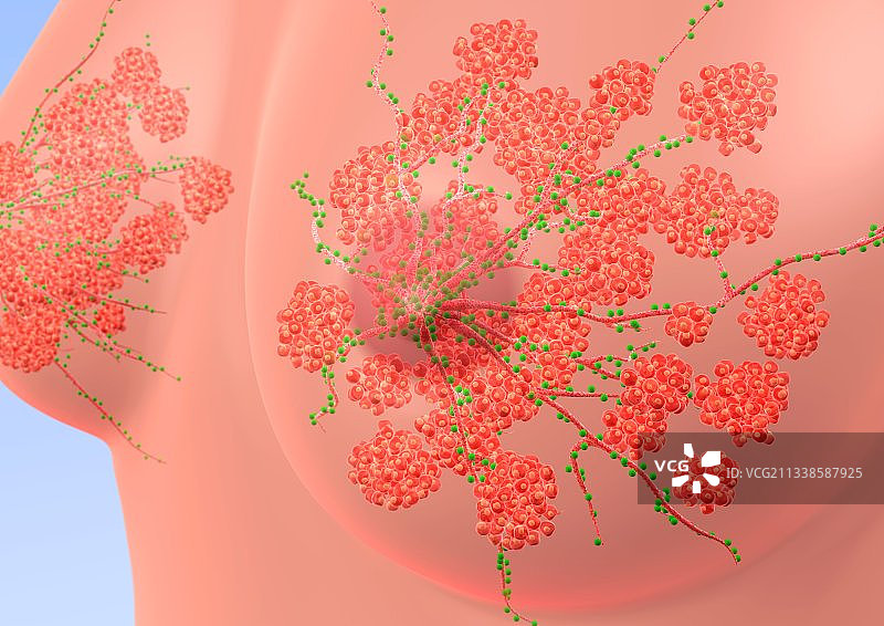 细菌性乳腺感染图片素材