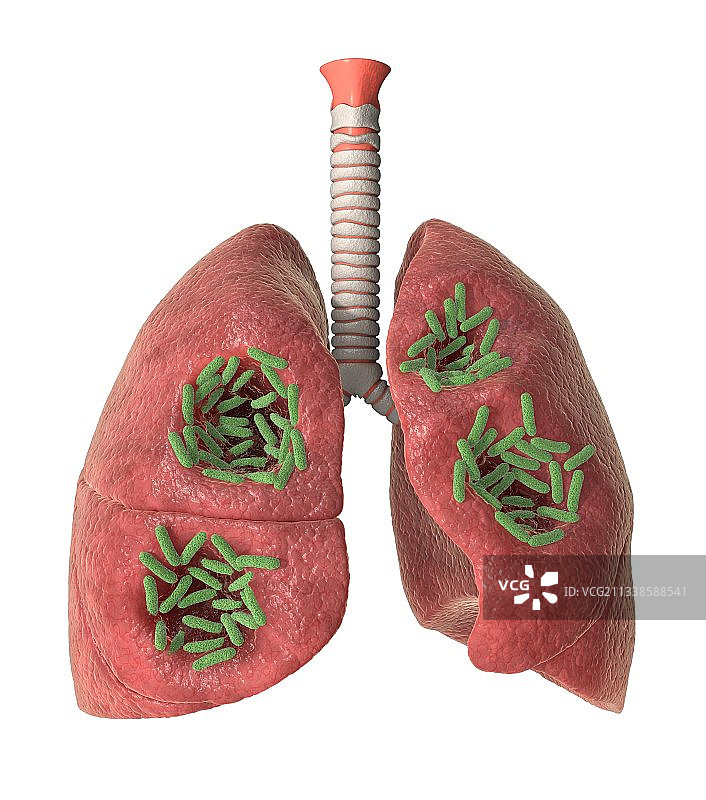 细菌性肺部感染医疗插画图片素材